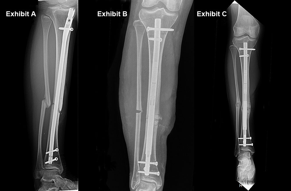 Progression of infected tilia nonunion